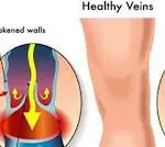 _-25D8-25A7-25D9-2584-25D8-25AF-25D9-2588-25D8-25A7-25D9-2584-25D9-258A-2BVaricose-2BVein-2B.webp الدوالي Varicose Vein