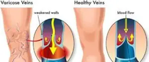 الدوالي Varicose Vein