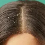 -25D9-2582-25D8-25B4-25D8-25B1-25D8-25A9-2B-25D8-25A7-25D9-2584-25D8-25B4-25D8-25B9-25D8-25B1-2BDandruff.webp قشرة الشعر Dandruff