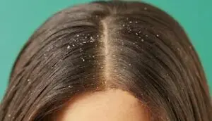 قشرة الشعر Dandruff