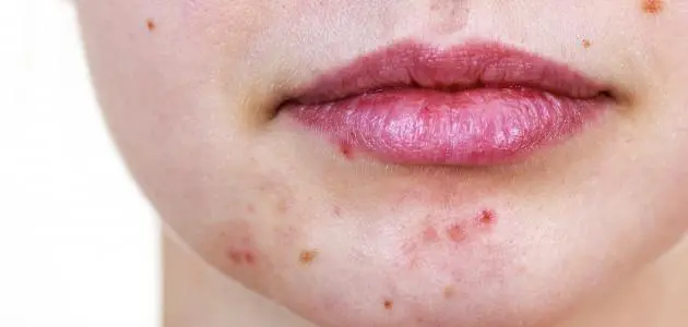 افضل طرق علاج حب الشباب