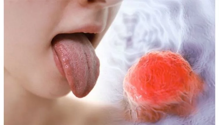 سرعة انتشار سرطان الفم