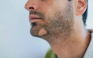الثعلبة البقعية