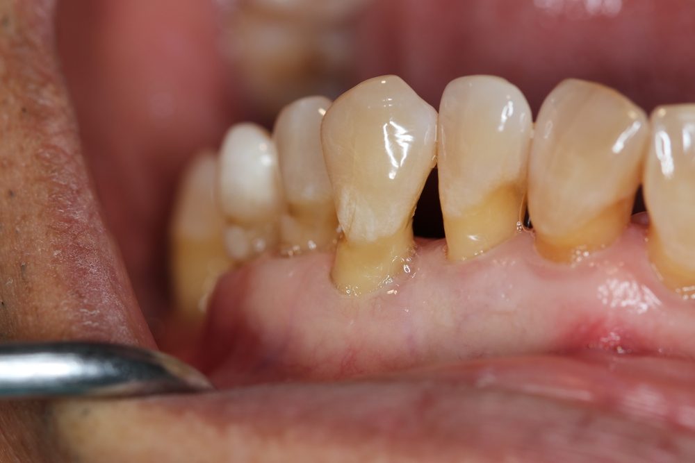 العناية بصحة الاسنان عند كبار السن