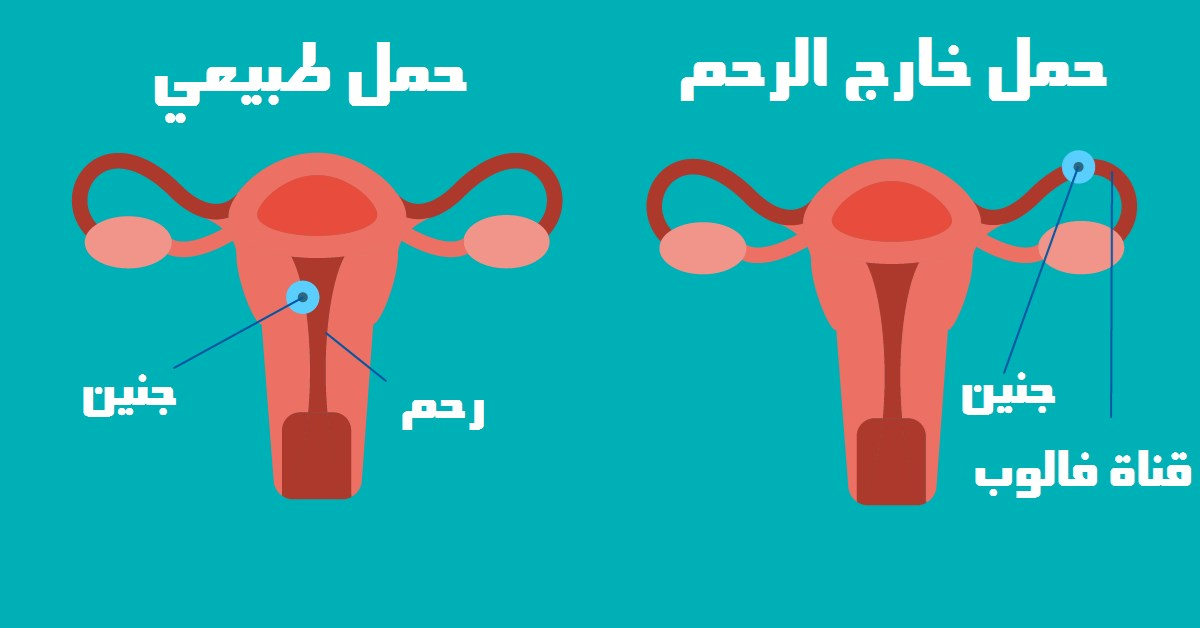 الفرق بين الحمل الطبيعي والحمل خارج الرحم