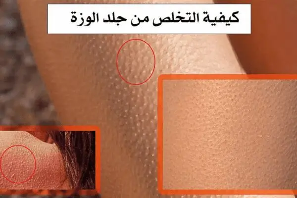 طريقة استخدام كريم اكرتين لعلاج جلد الوزة