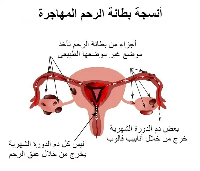 تجربتي مع بطانة الرحم المهاجرة