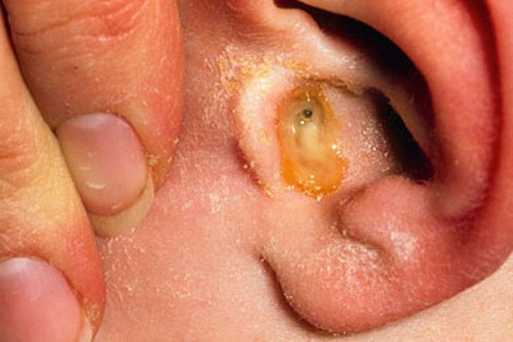 متى يكون التهاب الأذن خطير