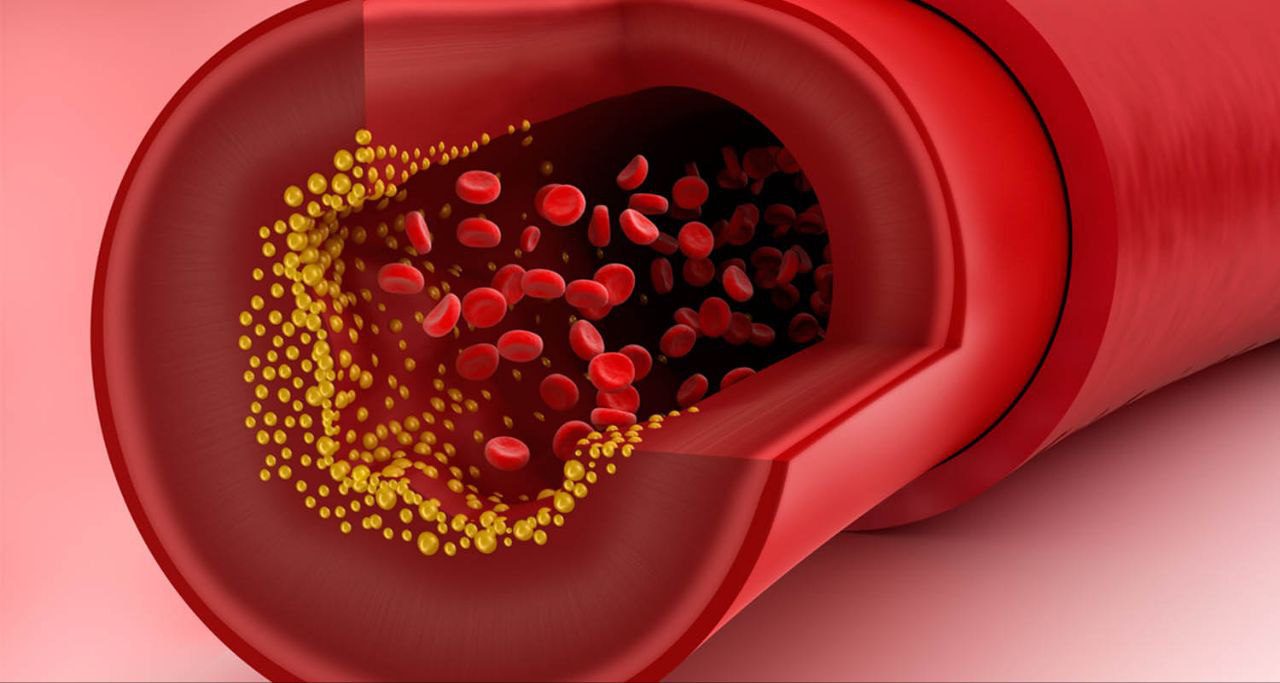 ما هي اسباب ارتفاع الكولسترول في الدم