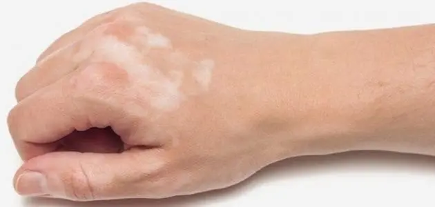 أعراض نقص صبغة الميلانين