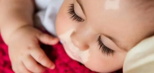 ما هو الفيتامين الذي يساعد على زيادة صبغة الميلانين