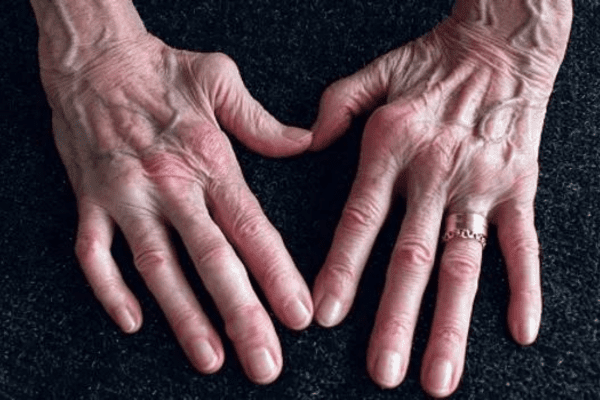 أعراض الروماتويد في اليد