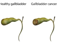 سرطان المرارة Gallbladder cancer