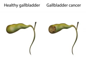 سرطان المرارة Gallbladder cancer
