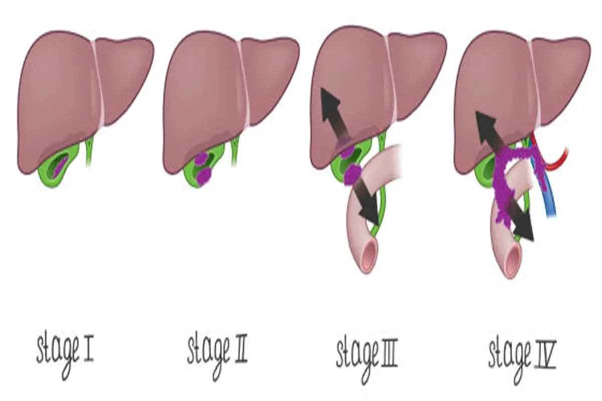سرطان المرارة Stages of gallbladder cancer