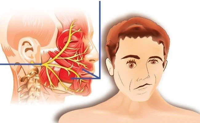 اعراض التهاب العصب الخامس والسابع