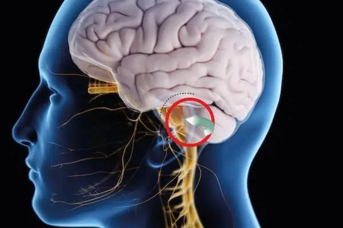 التهاب العصب الخامس