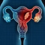 Symptoms of cervical cancer أعراض سرطان عنق الرحم