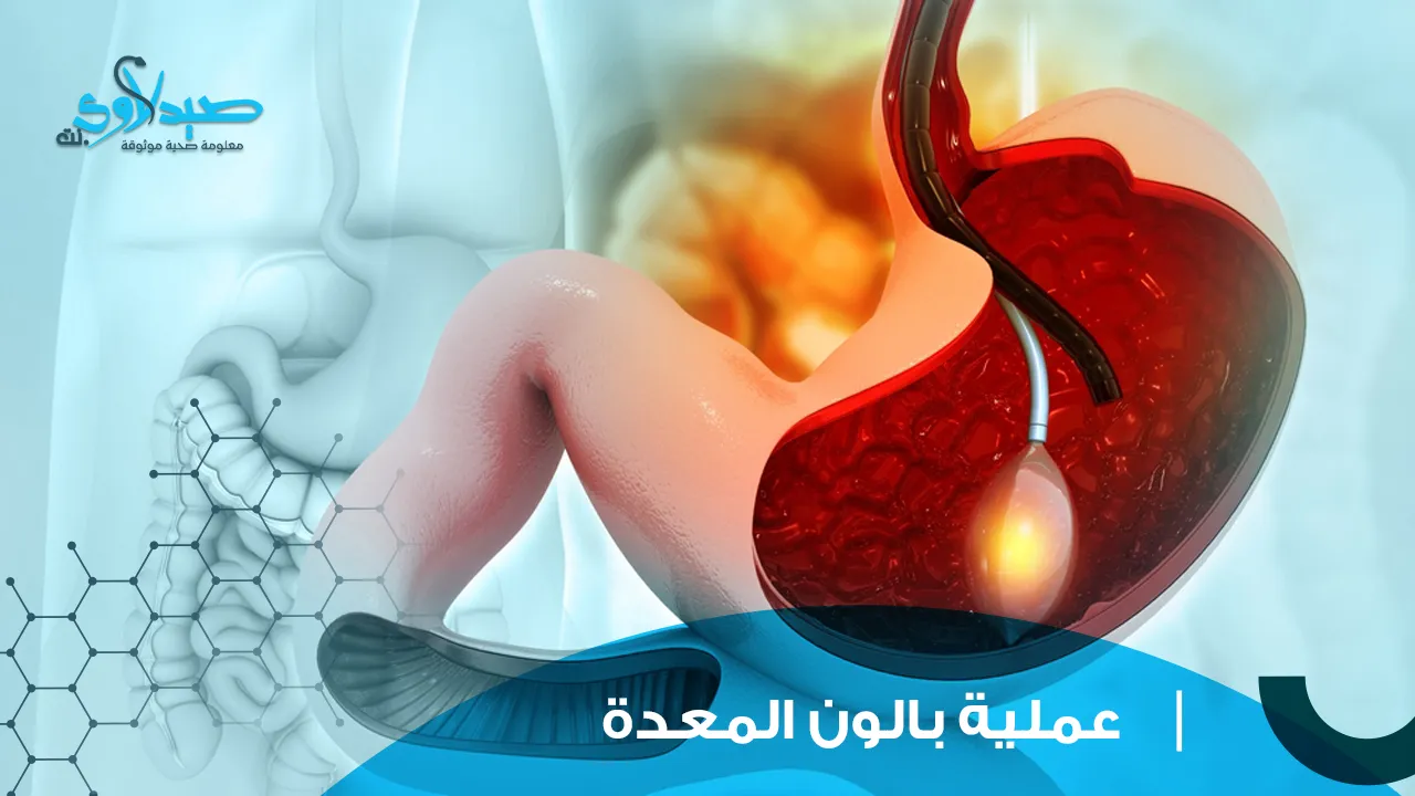 عملية بالون المعدة