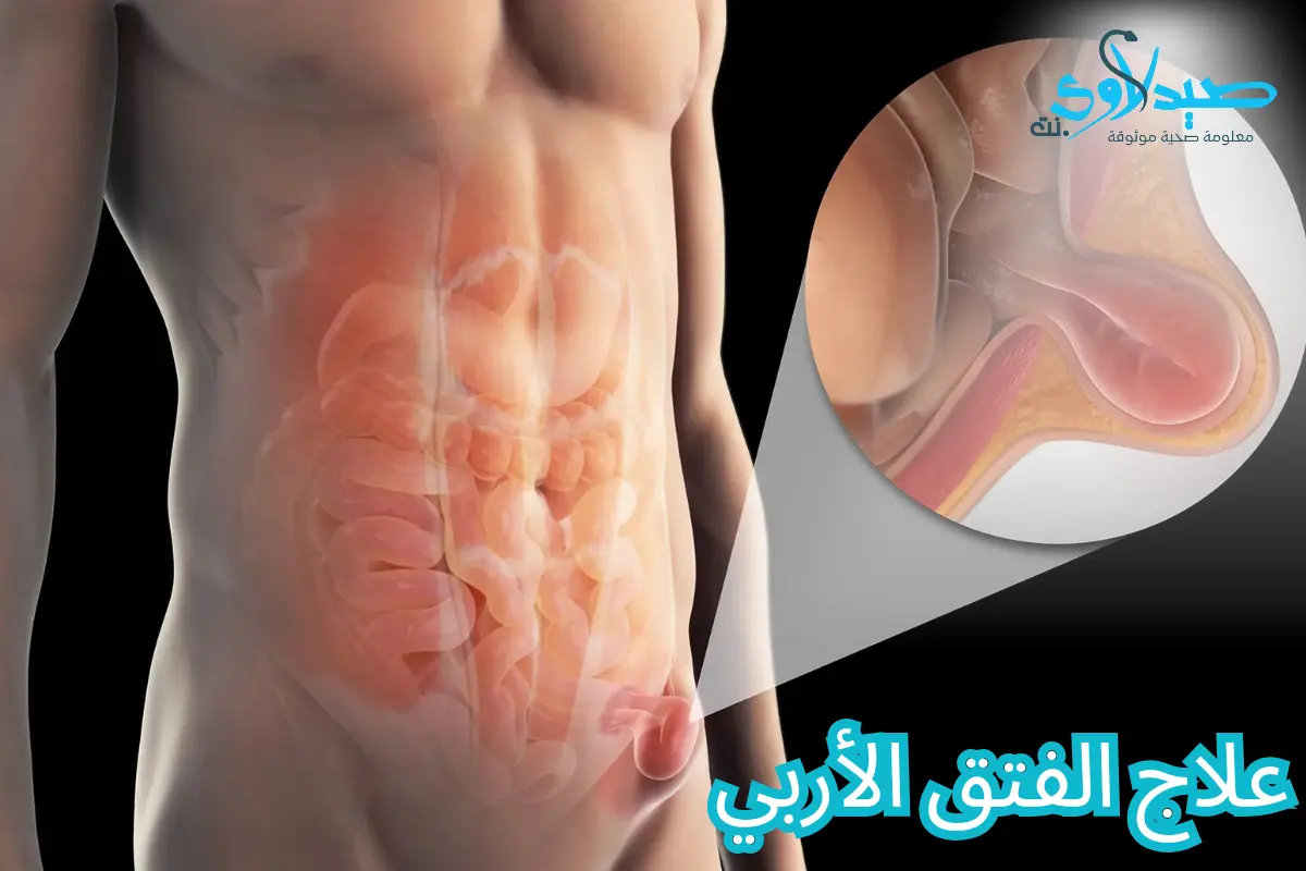 علاج الفتق الأربي