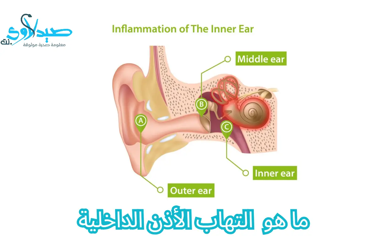 التهاب الأذن الداخلية
