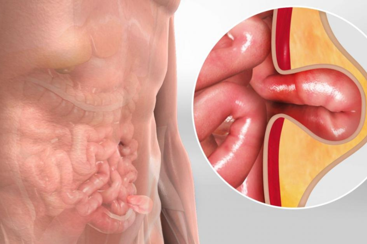 Causes of inguinal hernia