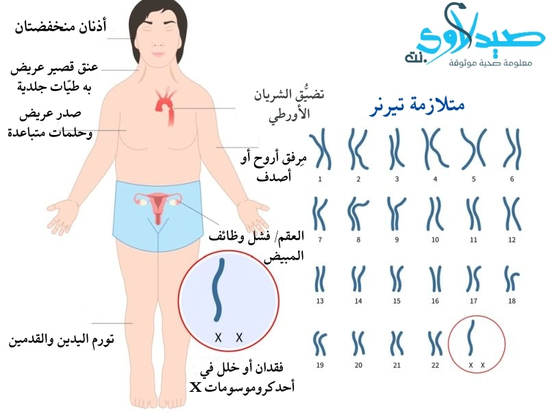 متلازمة تيرنر