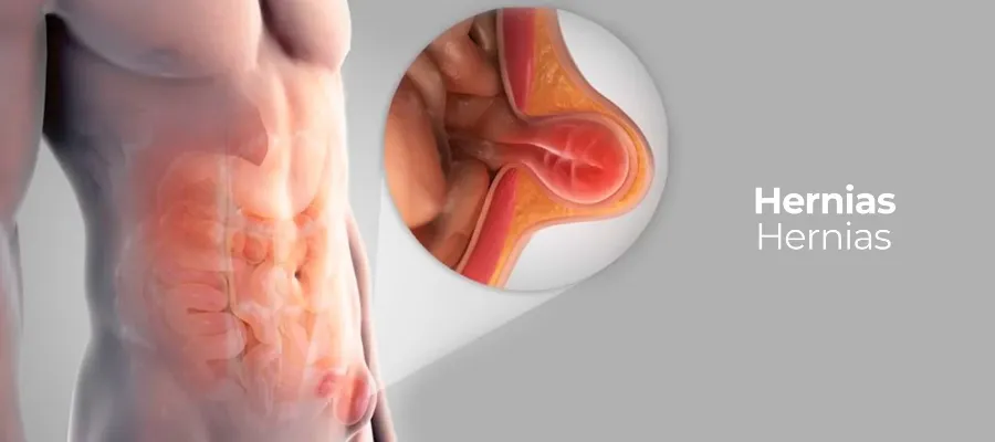 مضاعفات الفتق الأربي