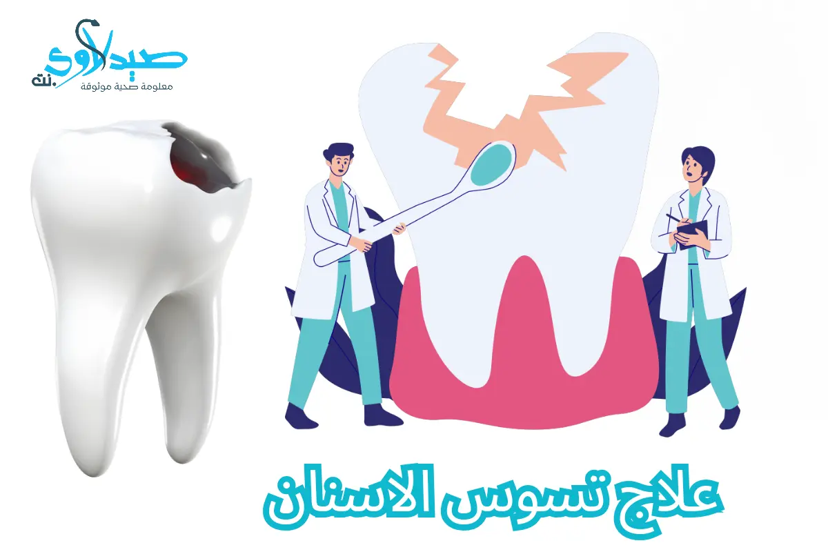 علاج تسوس الاسنان| أحدث التقنيات والأساليب الفعّالة و4 عادات يومية تجنبك التسوس