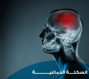 السكتة الدماغية