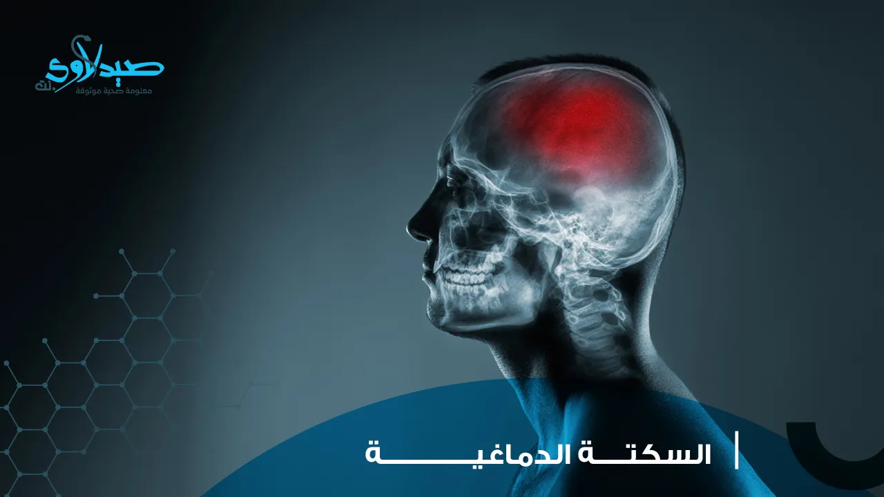 السكتة الدماغية