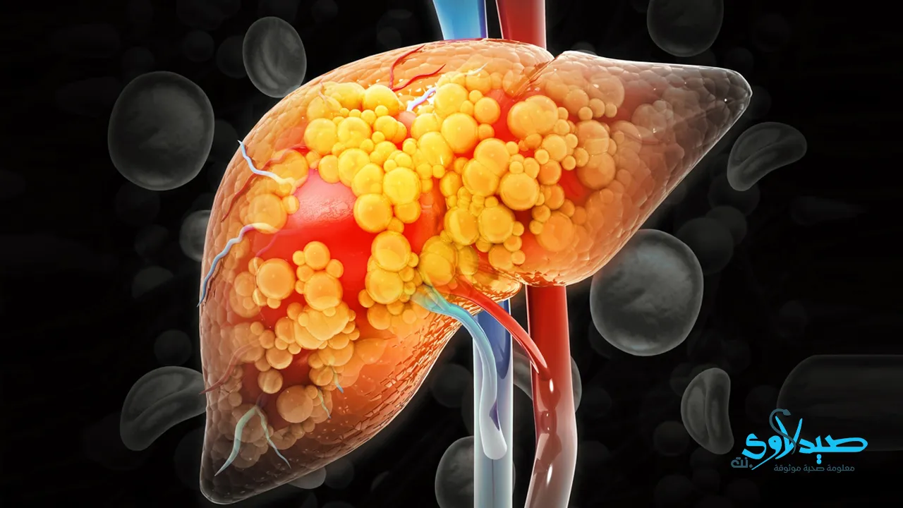 الكبد الدهني