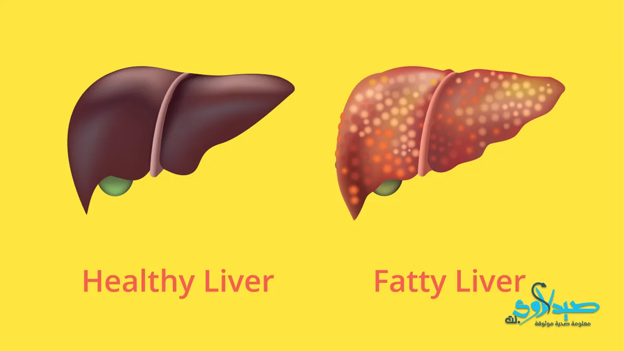 الكبد الدهني