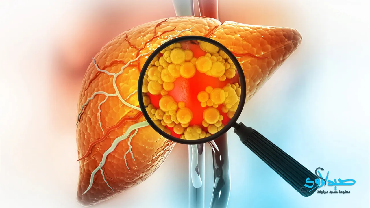 الكبد الدهني