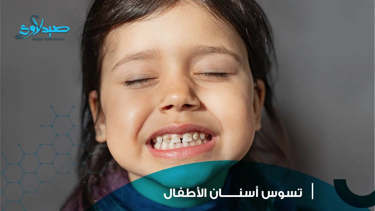تسوس أسنان الأطفال