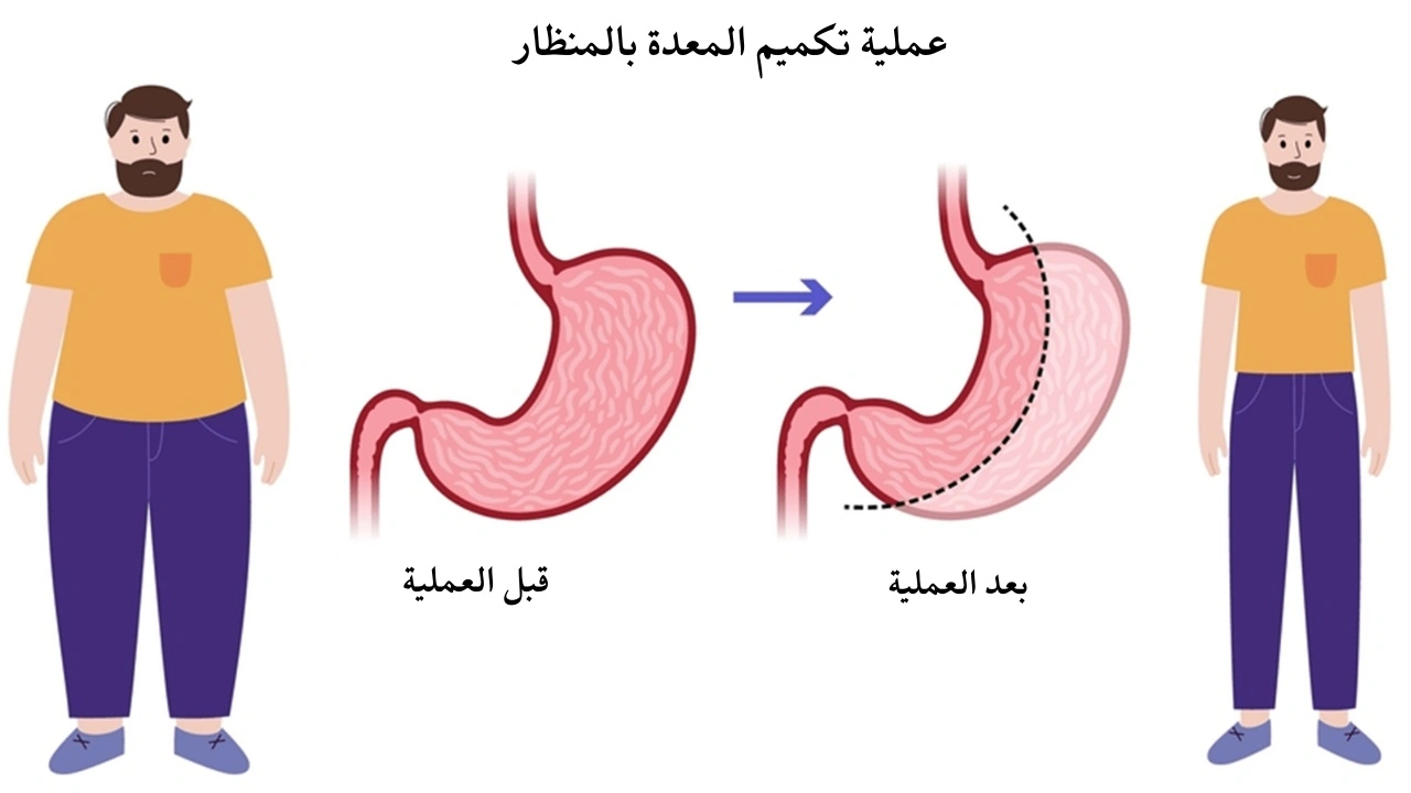 عملية تكميم المعدة بالمنظار