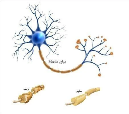 التصلب اللويحي المتعدد