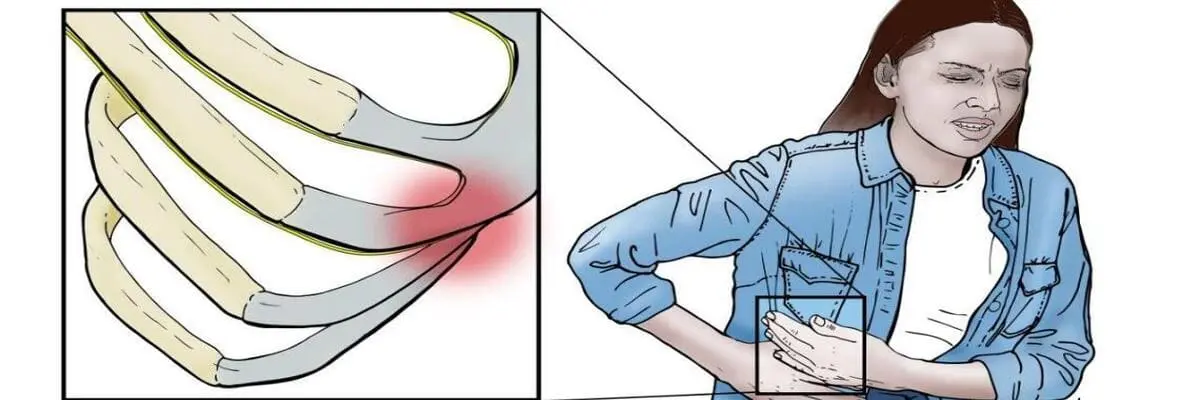 متلازمة الضلع المنزلق