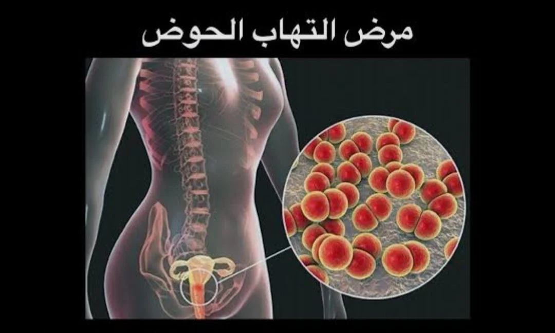 مرض التهاب الحوض