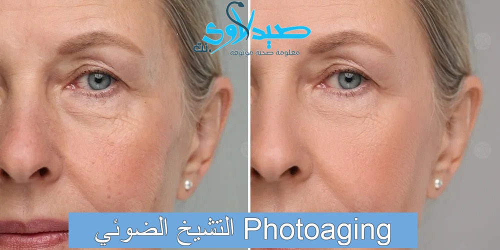 التشيخ الضوئي Photoaging