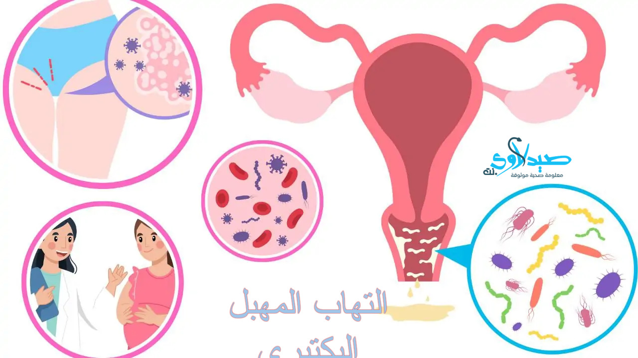 التهاب المهبل البكتيري