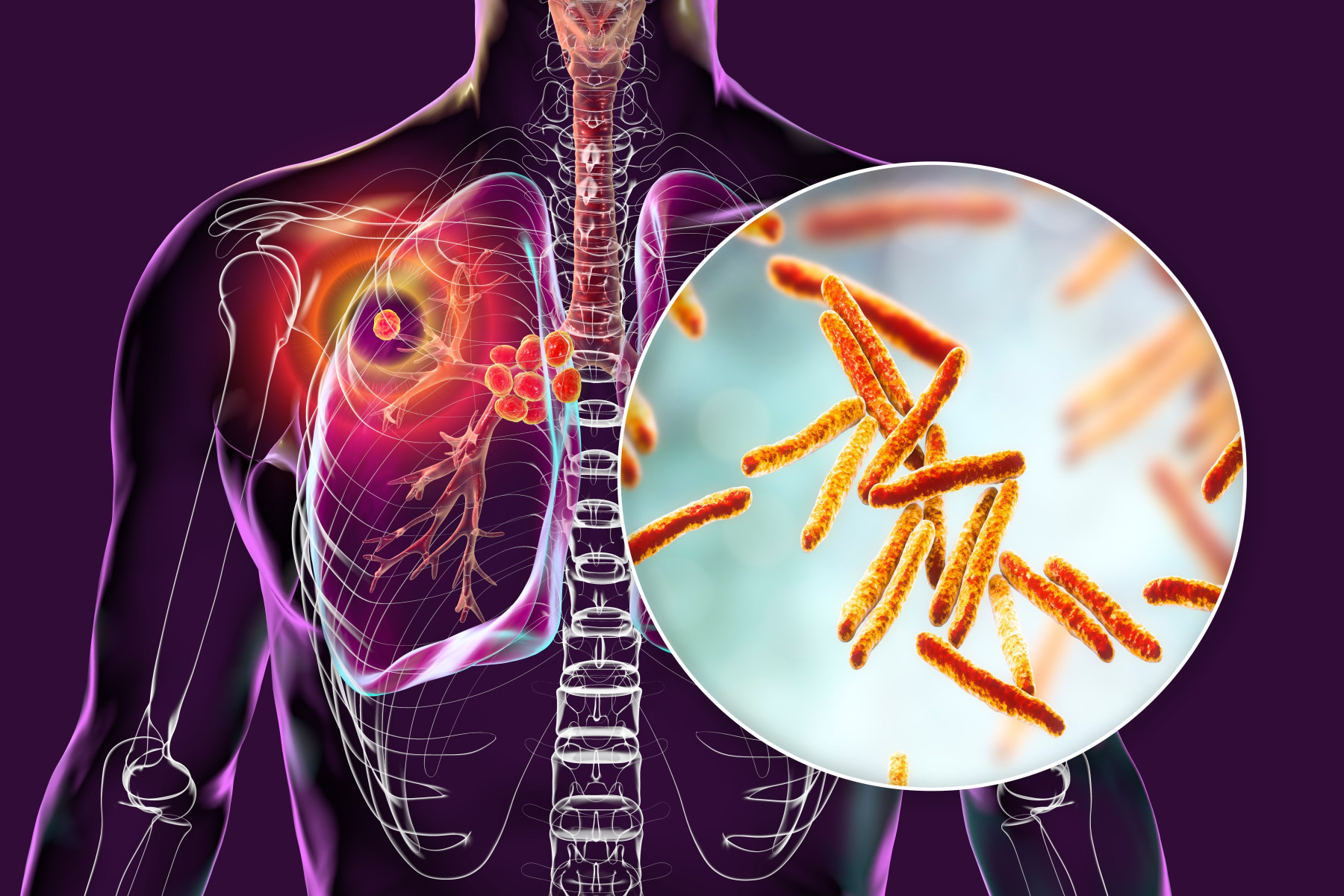 مرض السل Tuberculosis