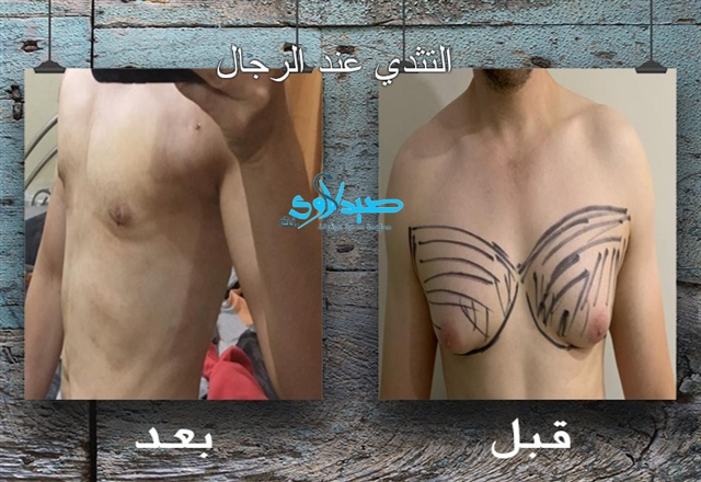 التثدي عند الرجال