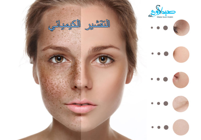 التقشير الكيميائي
