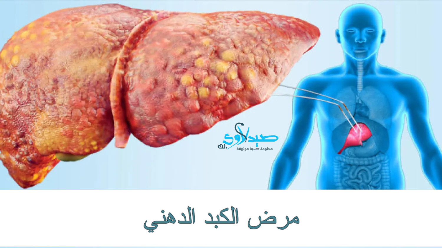مرض الكبد الدهني