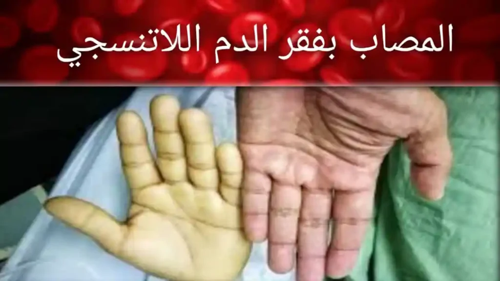 فقر الدم اللاتنسجي