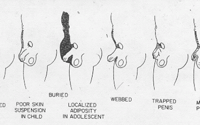 Buried Penis Syndrome
