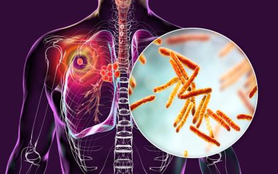 مرض السل Tuberculosis