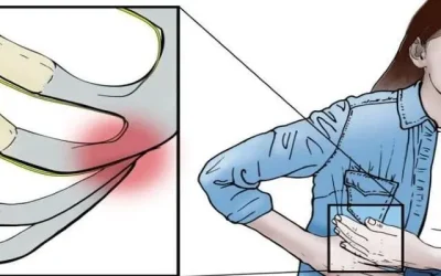متلازمة الضلع المنزلق