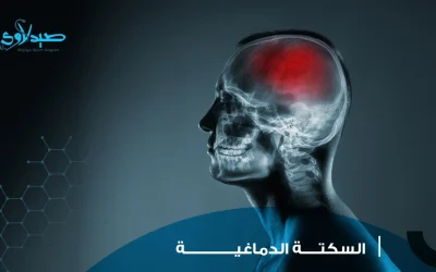 السكتة الدماغية